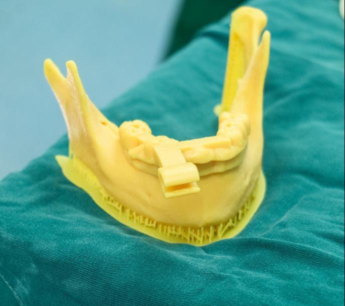3D打印数字化颌骨定位导板 3D打印数字化颌骨定位导板