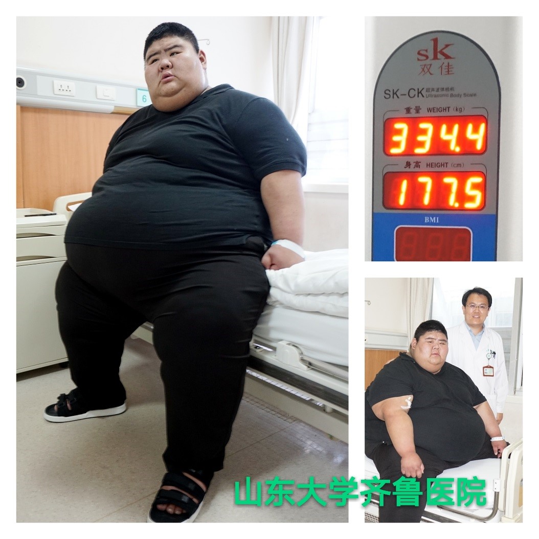 “山东第一胖”齐鲁医院减重纪实(一)