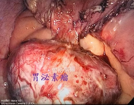 图4:十二指肠升段和水平段外生性胃泌素瘤(术中) 图4:十二指肠升段和水平段外生性胃泌素瘤(术中)