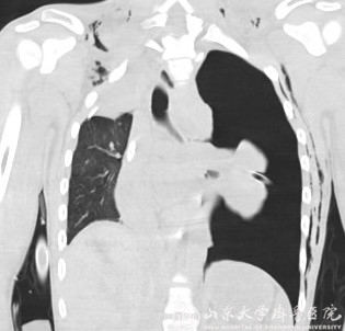 MDT与ECMO强强联手,齐鲁医院成功救治支气管断裂病人一例