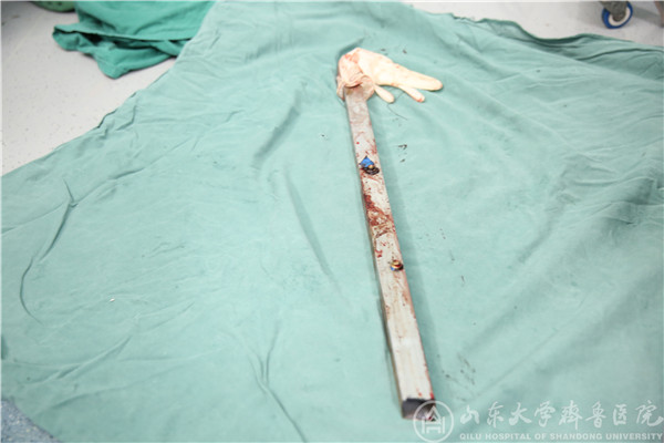 钢筋贯穿头部 10小时手术司机成功获救