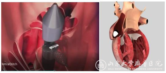 心脏外科成功完成山东省首例经导管二尖瓣修复术(MitralStitch)