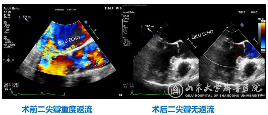 心脏外科成功完成山东省首例经导管二尖瓣修复术(MitralStitch)